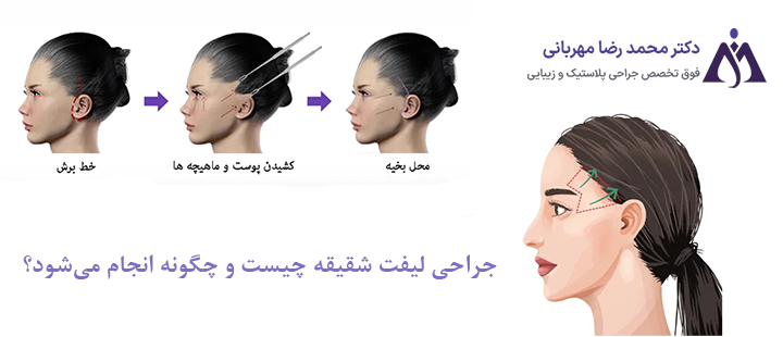 جراحی لیفت شقیقه چیست؟