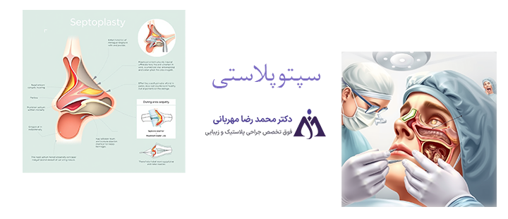 آشنایی با سپتوپلاستی 