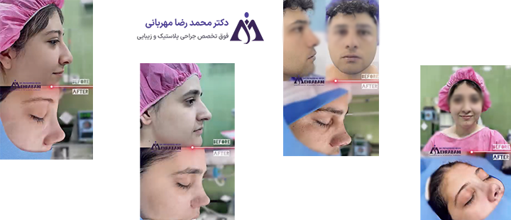 نمونه کارهای جراحی بینی دکتر مهربانی 