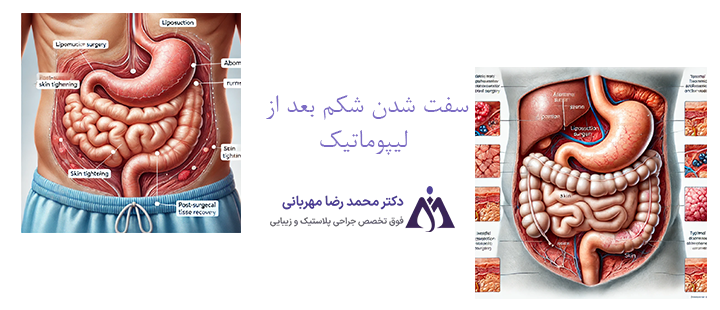 درباره سفت شدن شکم بعد از لیپوماتیک